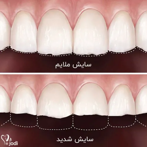 سایش دندان