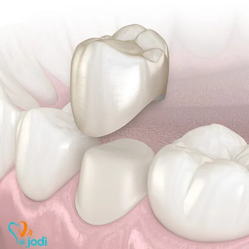 مشکلات پس از روکش دندان