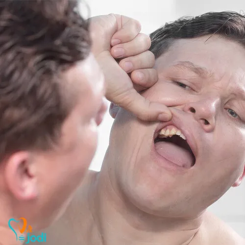 لق شدن ایمپلنت