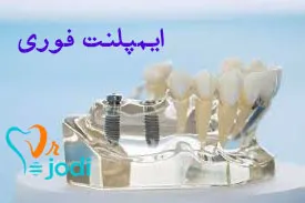 بهترین دکتر ایمپلنت فوری در تهران