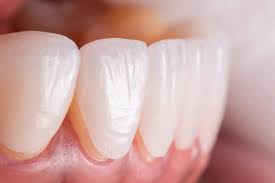 dental laminate