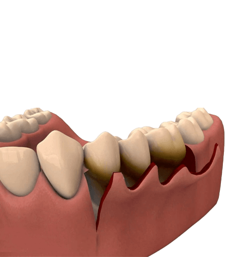 gum flap surgery