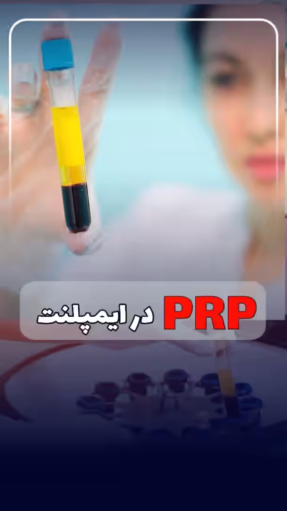 ایمپلنت PRP