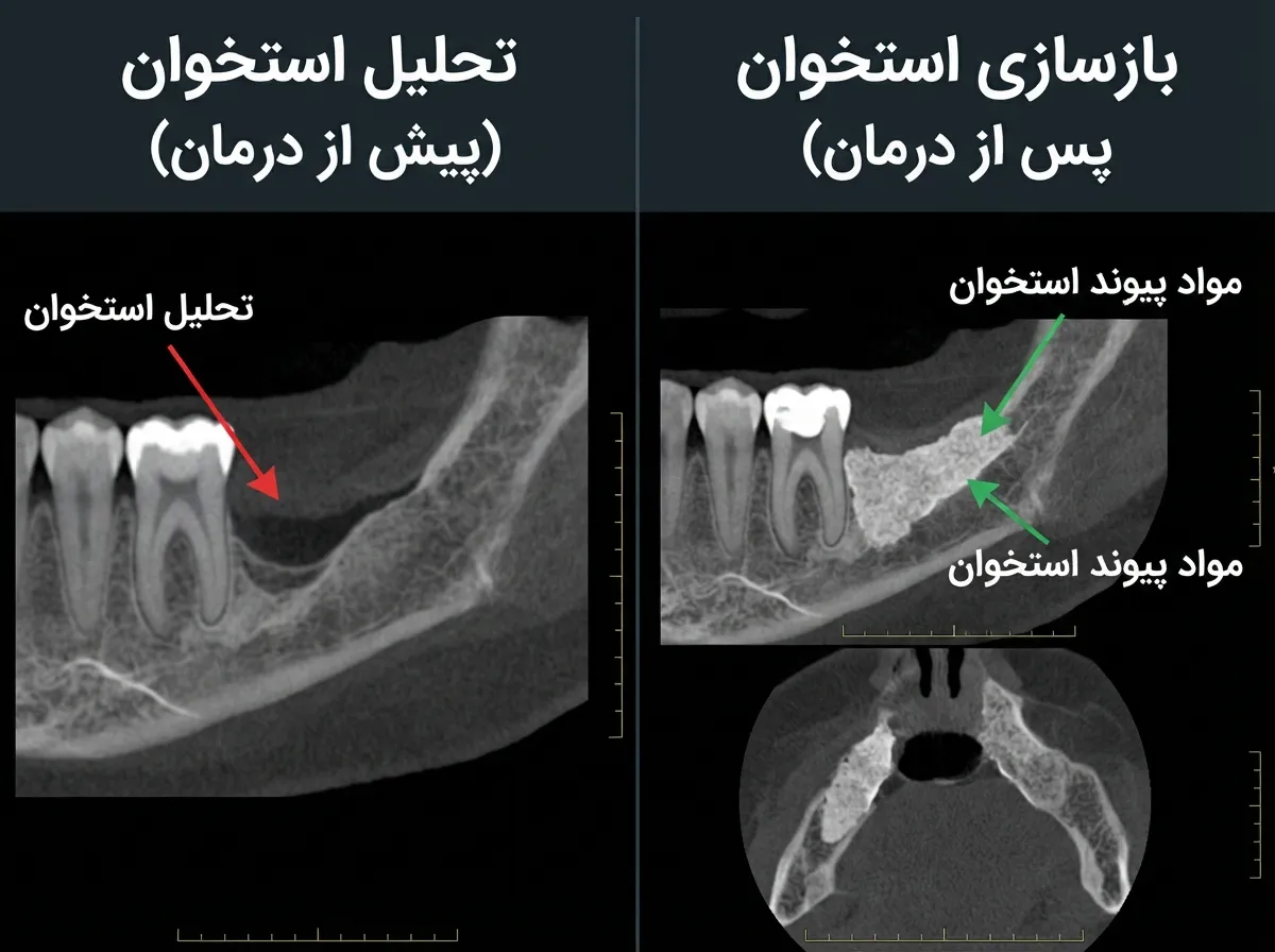 مراحل مختلف بازسازی استخوان فک با مواد پیوندی - از جراحی تا استخوان‌سازی کامل
