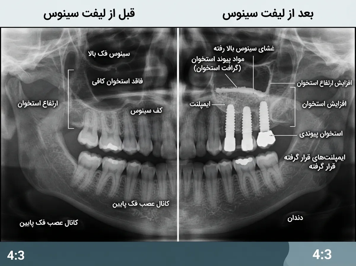 تصویر شماتیک جراحی سینوس لیفت فک بالا - فضای ایجاد شده برای قرارگیری ماده استخوانی و کاشت ایمپلنت دندان